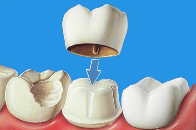 Dental crown