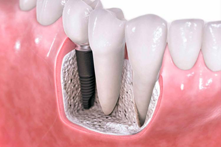 Dental implants